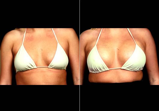 naturalfill breast enhancement before and after case 1